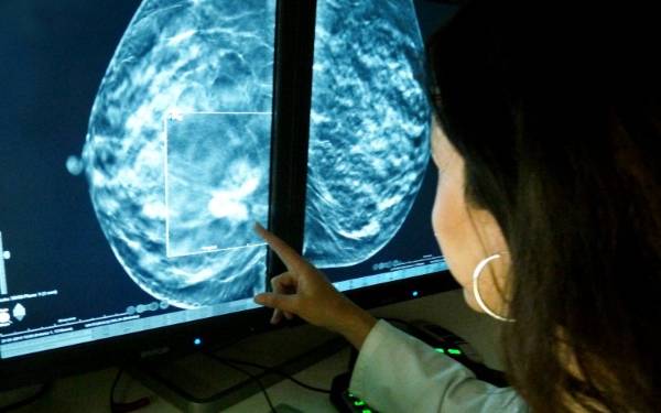 La IA detecta el 99% de los tumores de mama en cribados