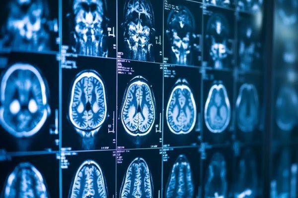 Un modelo de IA mejora imágenes de resonancia magnética para detectar anomalías cerebrales