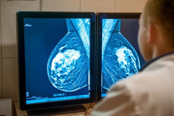 La IA revoluciona la detección temprana del cáncer de mama