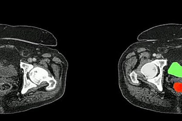 AbdomenAtlas: un avance en la detección temprana del cáncer abdominal